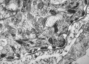 F,23y. | normal oral mucosal epithelium - hemidesmosomes and anchoring fibrils F,23y. | normal oral mucosal epithelium - hemidesmosomes and anchoring fibrils